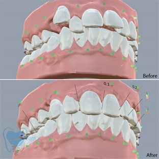 Kristelle Klear Aligners in Coimbatore